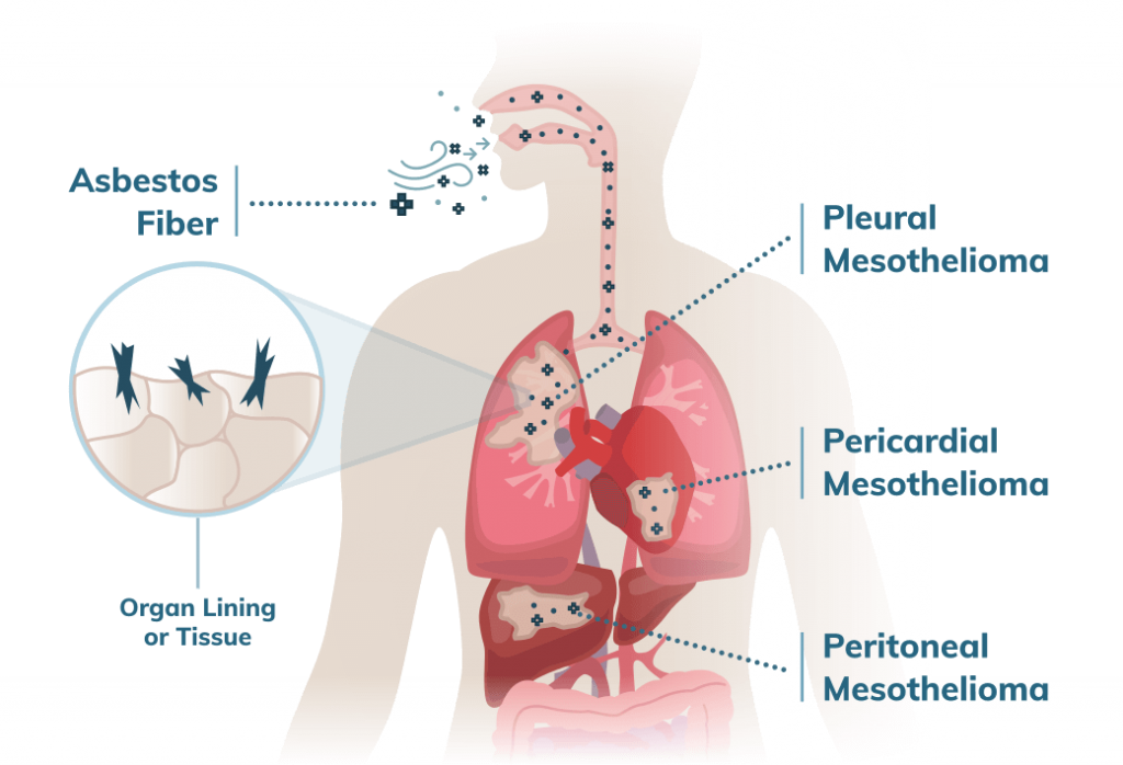 Mesothelioma-Lawyers
