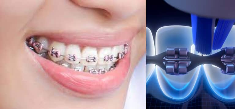 what-does-a-power-chain-for-braces-do